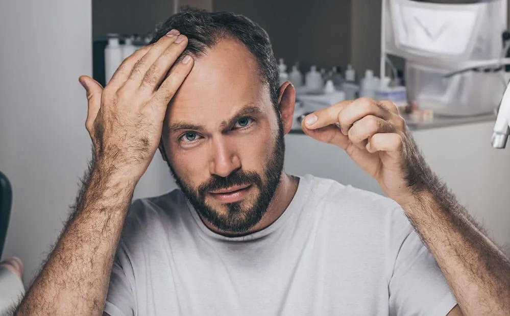 Estabilización de la alopecia androgénica Hombre revisando entradas por alopecia androgénica frente al espejo