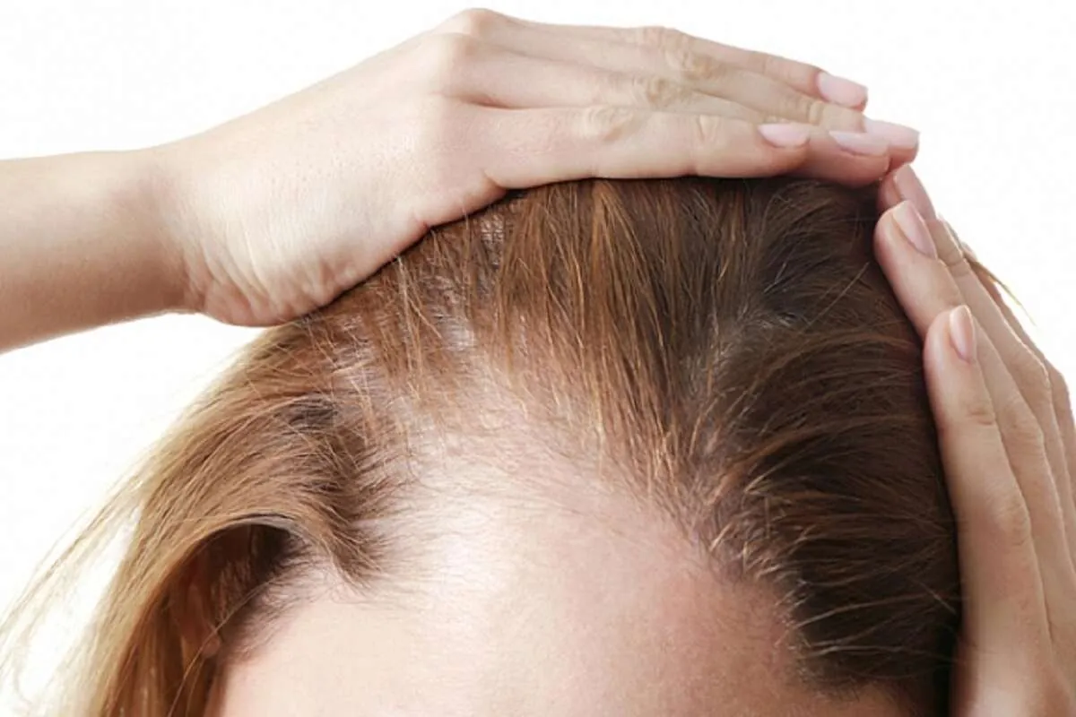 Mujer con entradas y caída de cabello por alopecia nerviosa