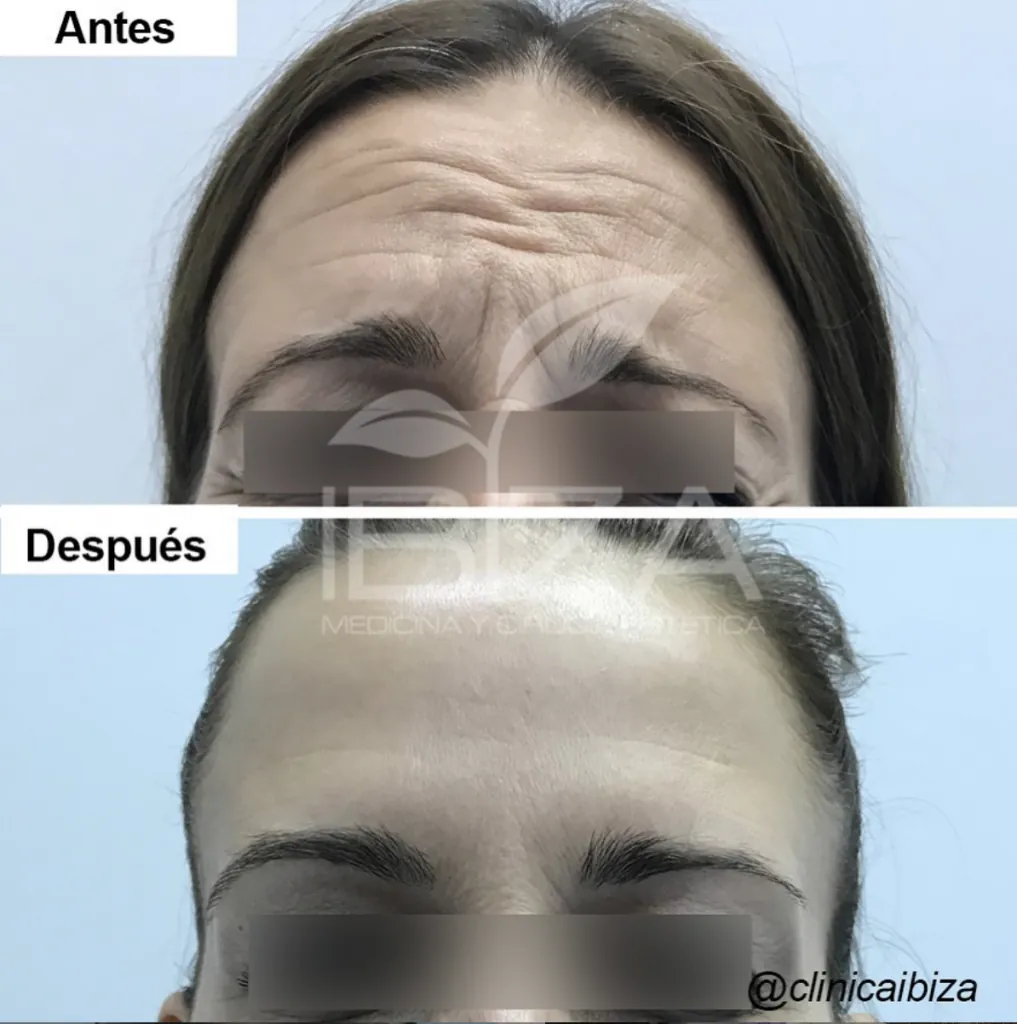 Baby Botox resultados frente Antes y después de tratamiento baby botox para arrugas frente