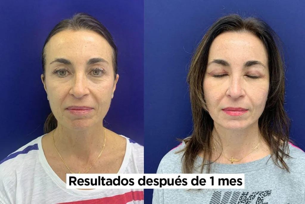 Comparativa antes y después blefaroplastia tras un mes de recuperación