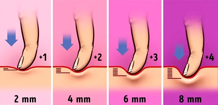 Grados de edema Grados de fóvea según profundidad en edema por retención de líquidos