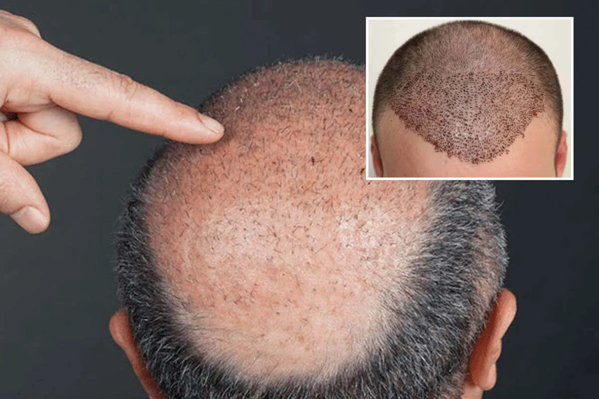 Costras tras injerto capilar visibles en cuero cabelludo con folículos implantados