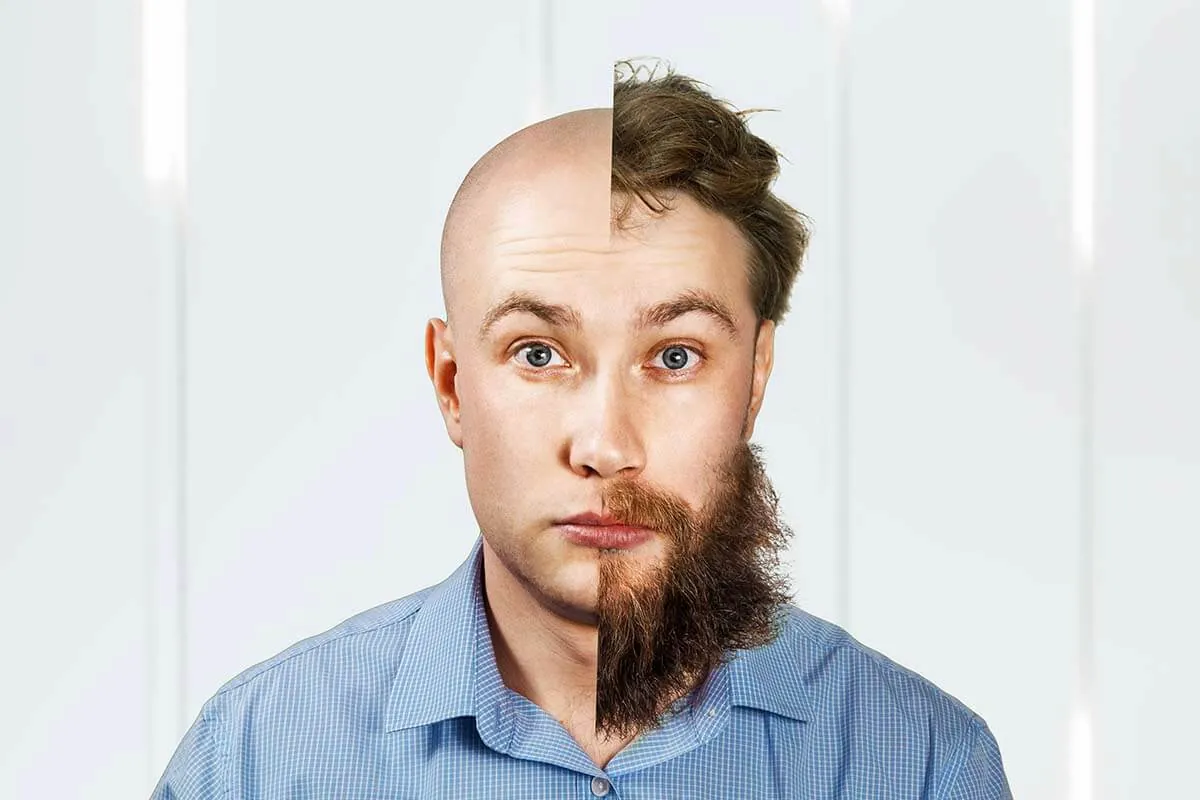 Duración del injerto capilar Hombre mostrando comparación antes y después de injerto capilar con barba