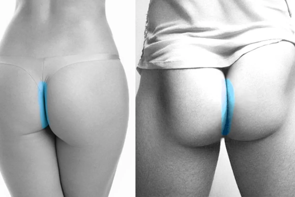 Depilación láser perianal Comparativa zona perianal femenina antes y después de depilación láser