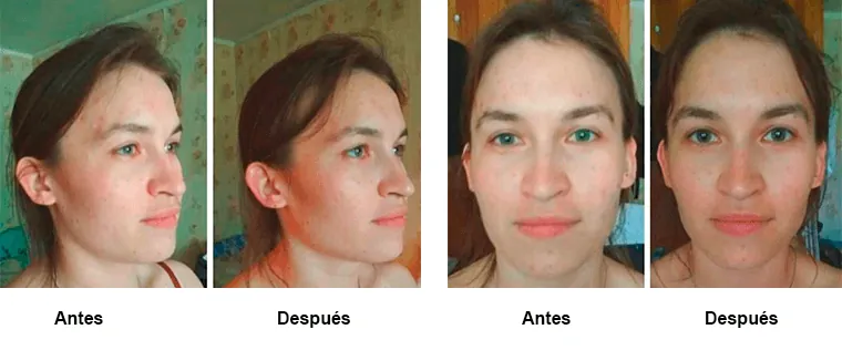 Comparativa antes y después de drenaje linfático facial en mujer