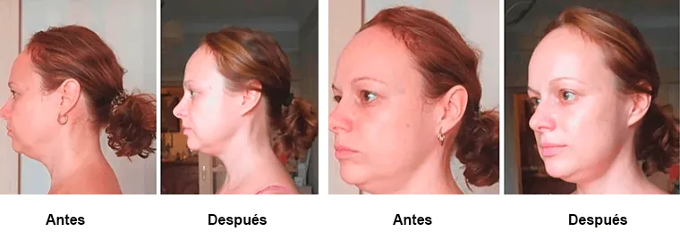 Resultados antes y después de drenaje linfático facial en mujer
