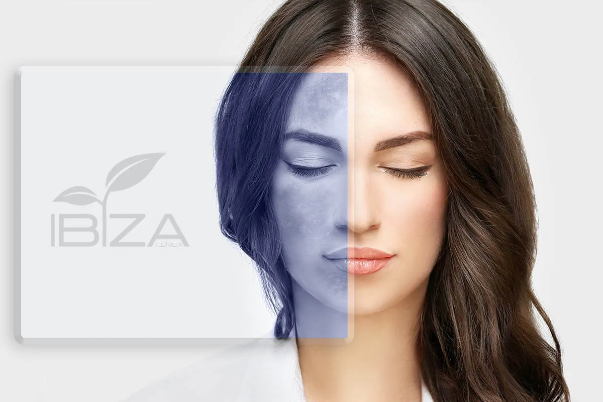 Eliminar melasma definitivamente Comparativa facial de tratamiento para eliminar el melasma definitivamente