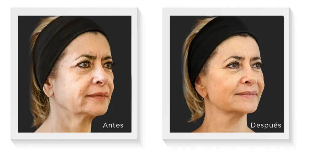 Ellansé antes y después, caso 1