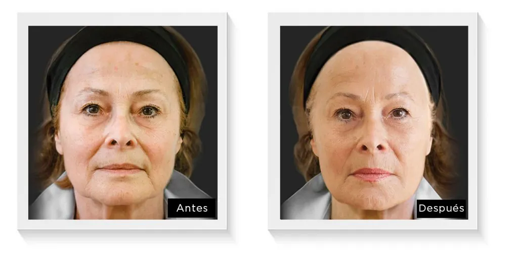 Ellansé antes y después, caso 2