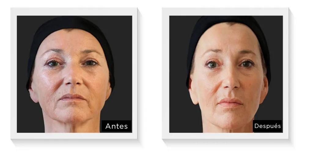 Ellansé antes y después, caso 3