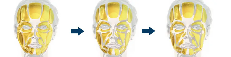 Evolución del envejecimiento facial y áreas tratables con Ellansé
