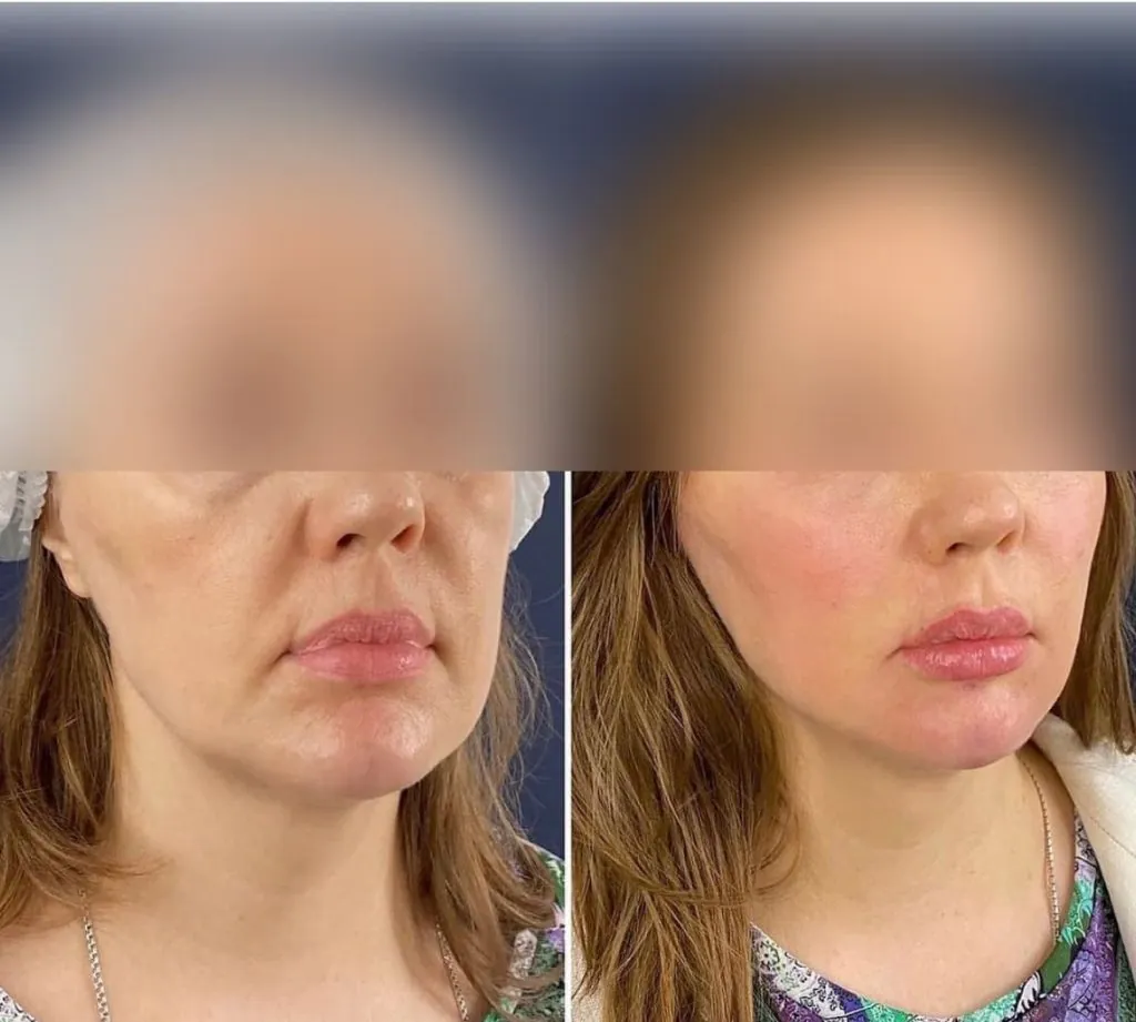 Comparativa Ellansé y Radiesse Resultado antes y después de tratamiento con Ellansé en contorno facial
