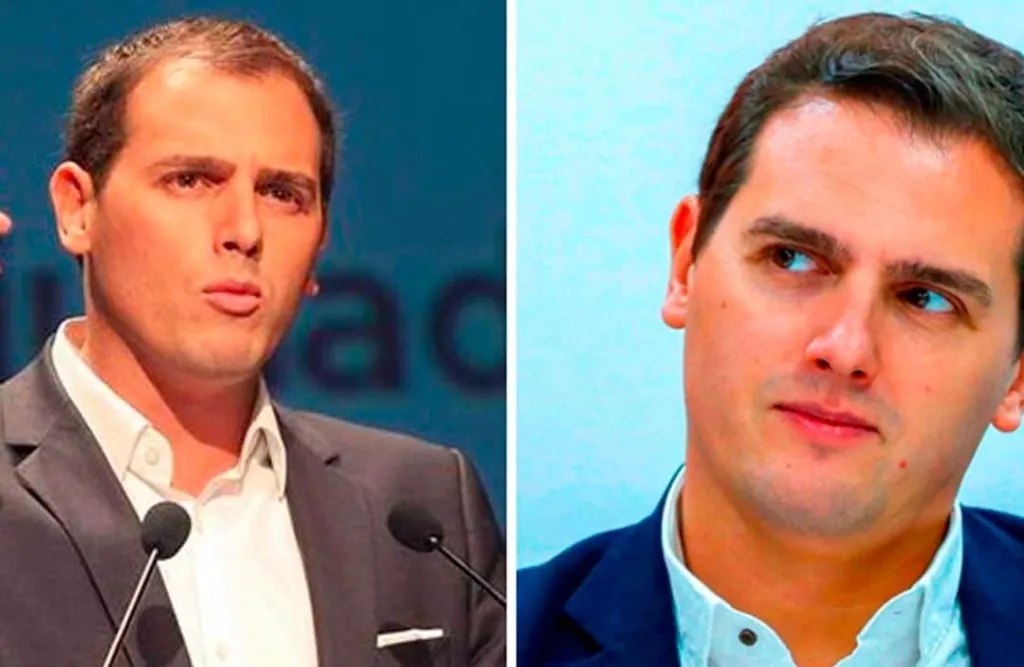 Político con trasplante capilar Comparativa antes y después de injerto capilar en político conocido