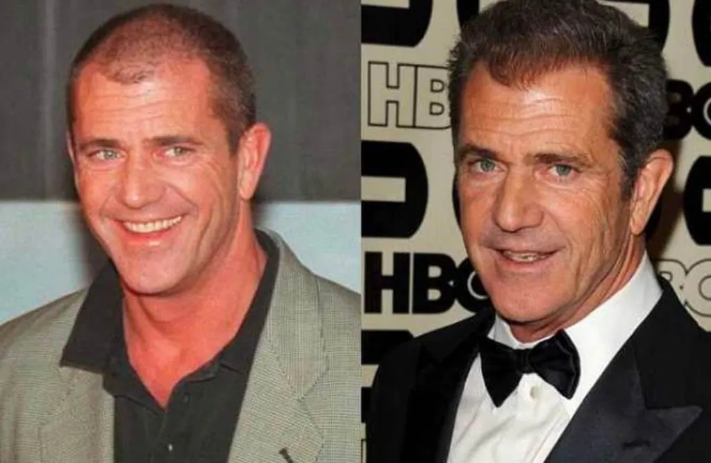 Trasplante capilar en famosos Actor famoso antes y después de un trasplante capilar