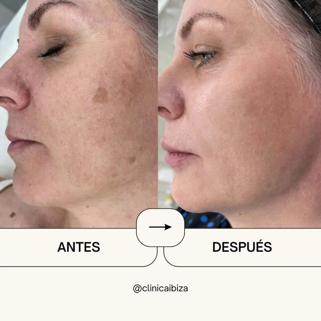 Antes y después de peeling de fenol facial: eliminación de manchas y rejuvenecimiento de la piel