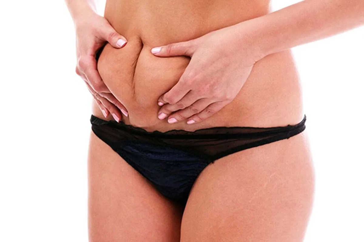 Flacidez abdominal en mujer Mujer mostrando flacidez abdominal sujetando piel del vientre con manos