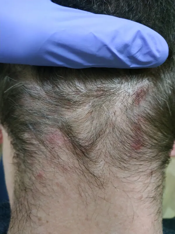 Foliculitis cuero cabelludo inflamación Foliculitis del cuero cabelludo con inflamación y enrojecimiento en área afectada del cabello