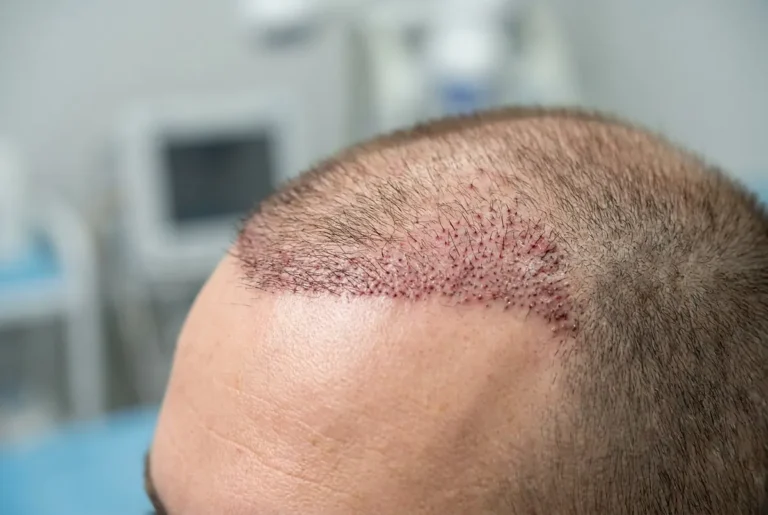 Foliculitis Después de un injerto capilar