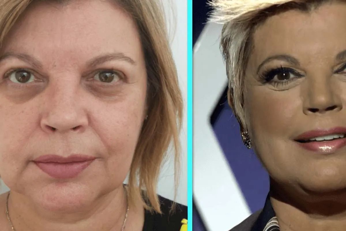 Hilos tensores faciales Comparativa antes y después de hilos tensores faciales en mujer