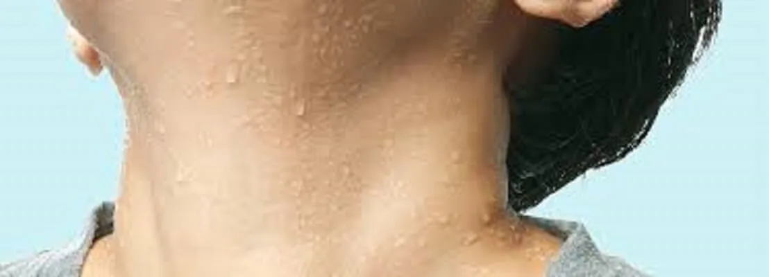 Hiperhidrosis facial y sudor Mujer con sudoración excesiva en el cuello y rostro por hiperhidrosis