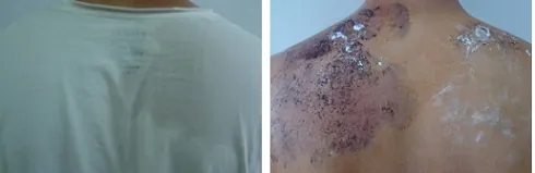 Comparativa hiperhidrosis axilar con sudoración excesiva y tratamiento aplicado