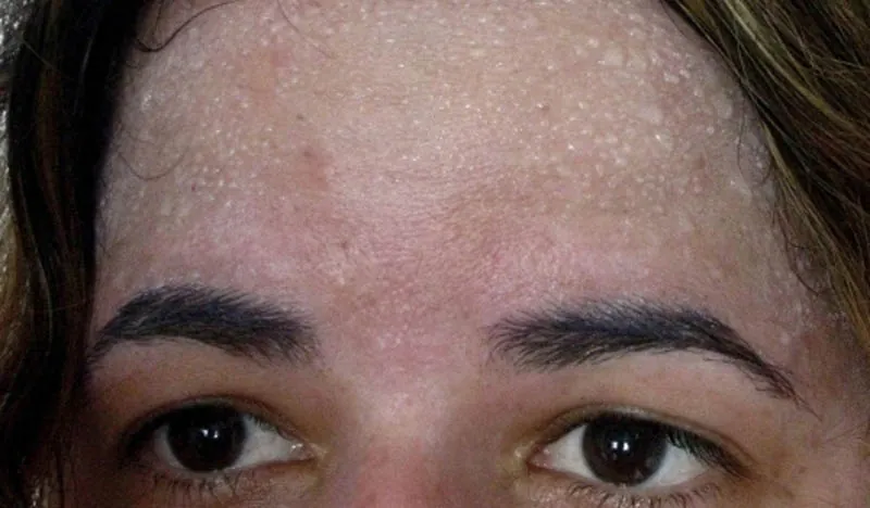 Frente femenina con gotas de sudor por hiperhidrosis facial