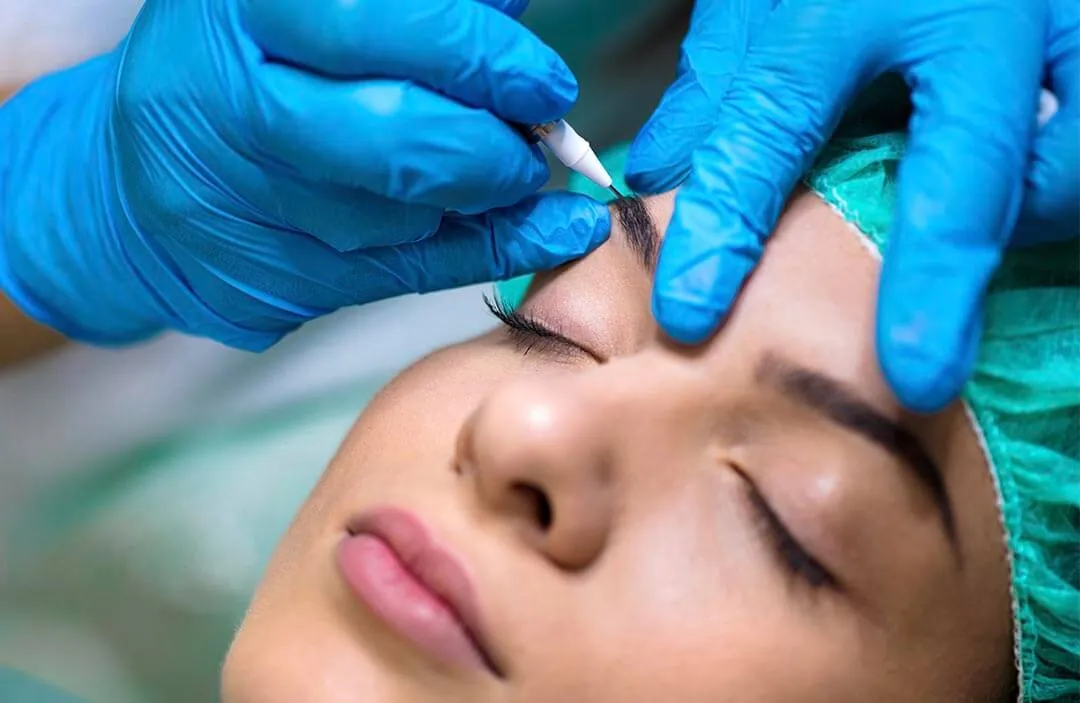 Microinjerto o implante de cejas con técnica FUE