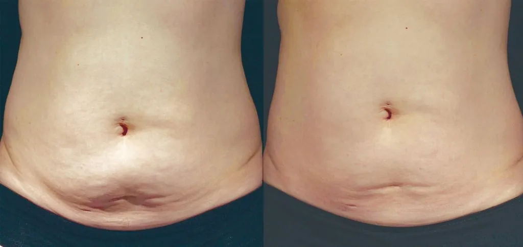 Resultados inductores de colágeno Antes y después de tratamiento con inductores de colágeno en abdomen