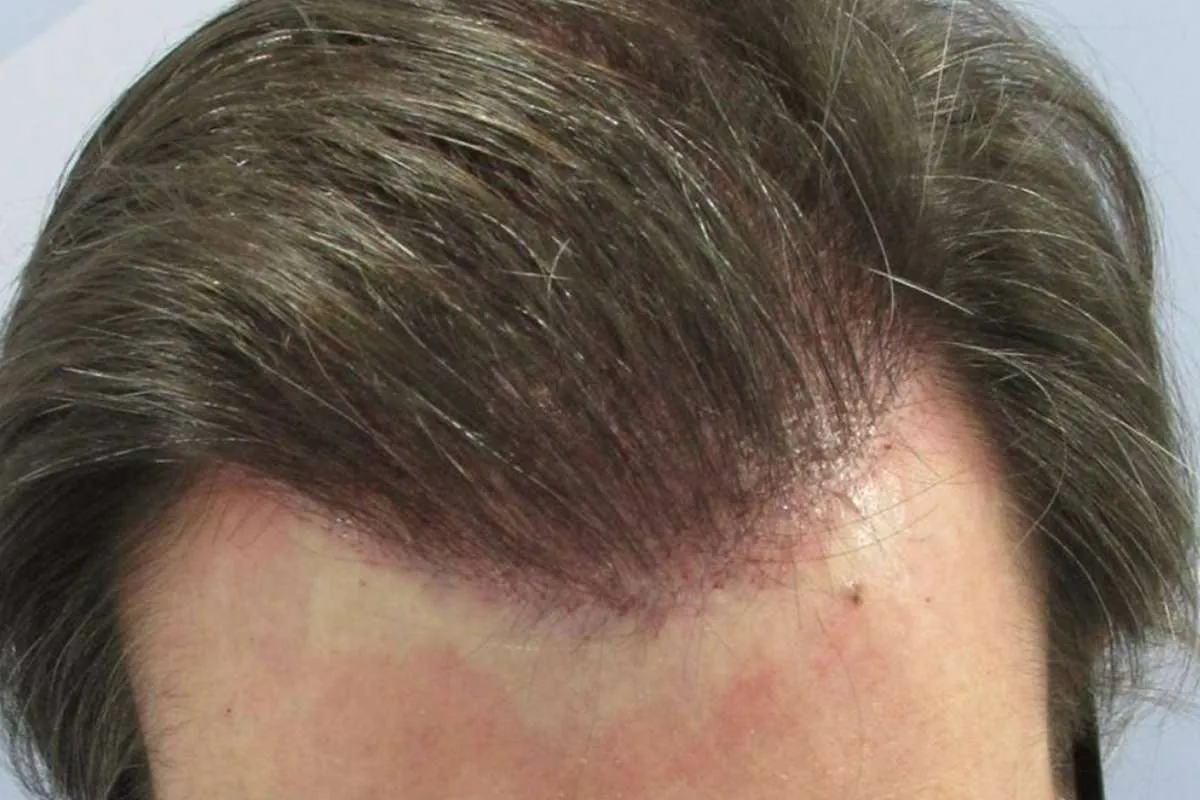 Injerto capilar sin rapar Resultado de injerto capilar sin rapar en línea frontal masculina