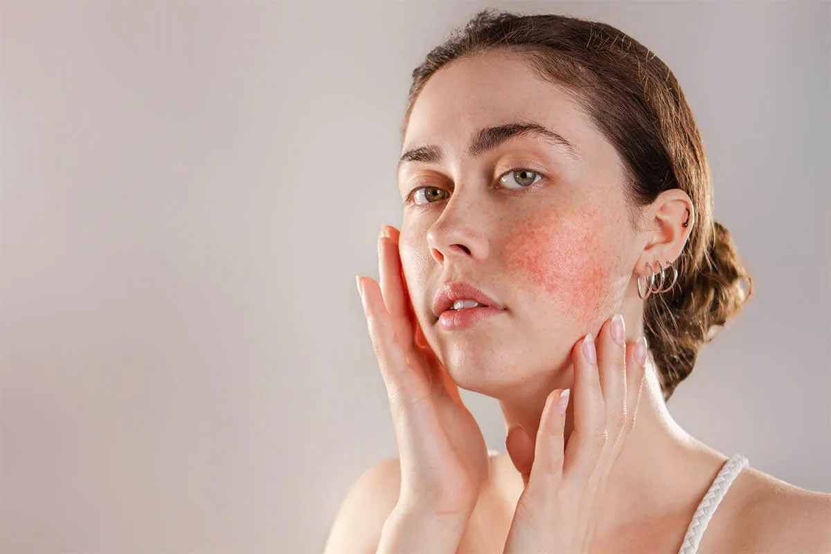 Rosácea facial en mujer Mujer joven con rosácea y enrojecimiento visible en las mejillas
