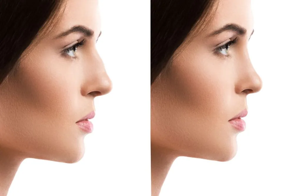 Rinomodelación con ácido hialurónico Perfil de mujer antes y después de levantar punta nariz con ácido hialurónico