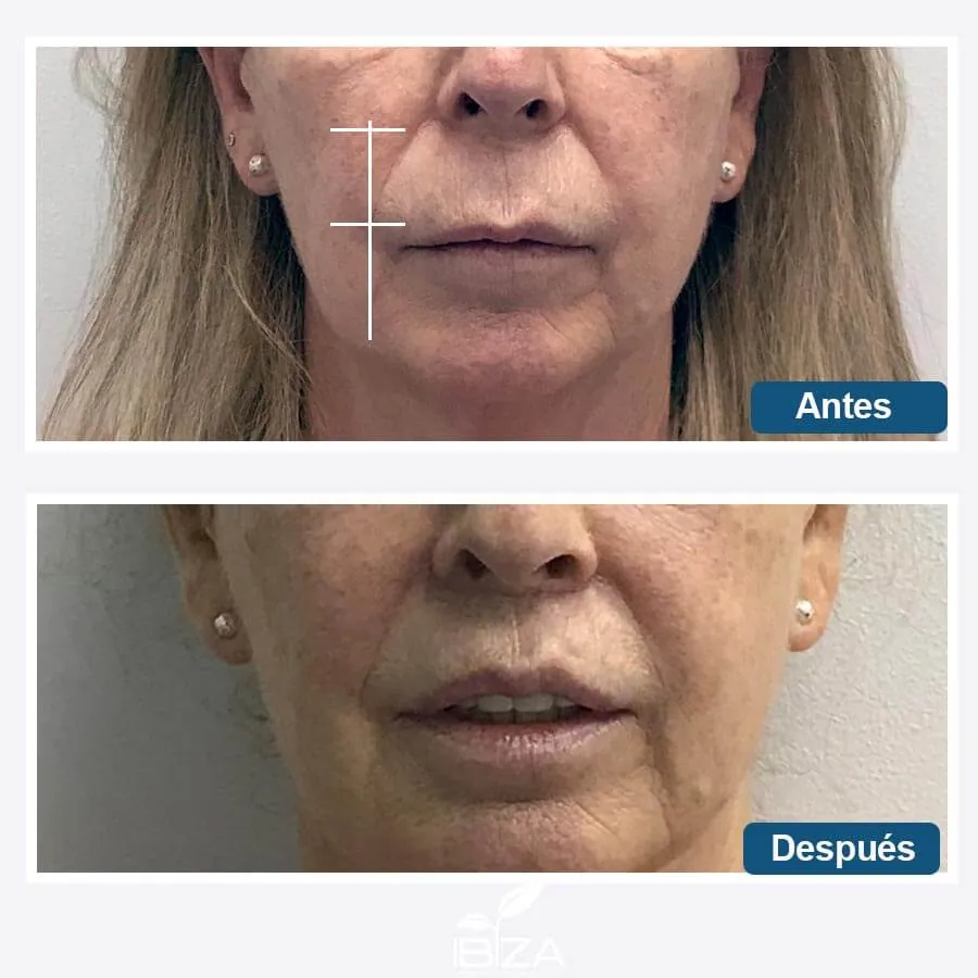 Resultado lip lift Antes y después de lip lift en labio superior femenino
