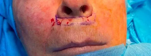Marcaje preoperatorio lip lift Marcaje quirúrgico bullhorn para lip lift en labio superior