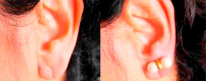 Lobuloplastia antes y después Comparativa antes y después de lobuloplastia para reconstrucción del lóbulo