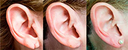 Resultados de lobuloplastia Antes y después de lobuloplastia para reconstrucción del lóbulo de la oreja