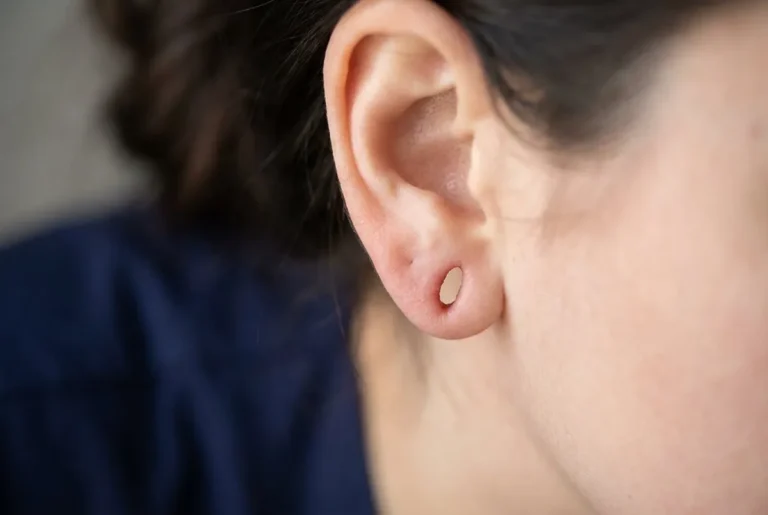 Lobuloplastia: Reconstrucción del lóbulo de la oreja