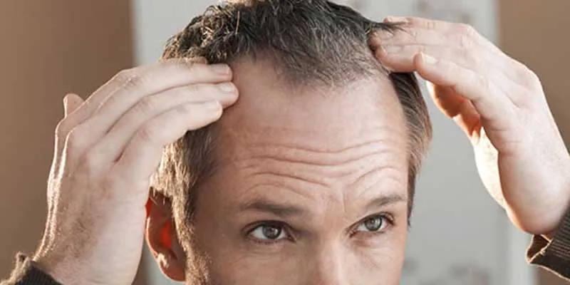 Edad ideal injerto capilar Hombre adulto revisando entradas y alopecia antes del injerto capilar