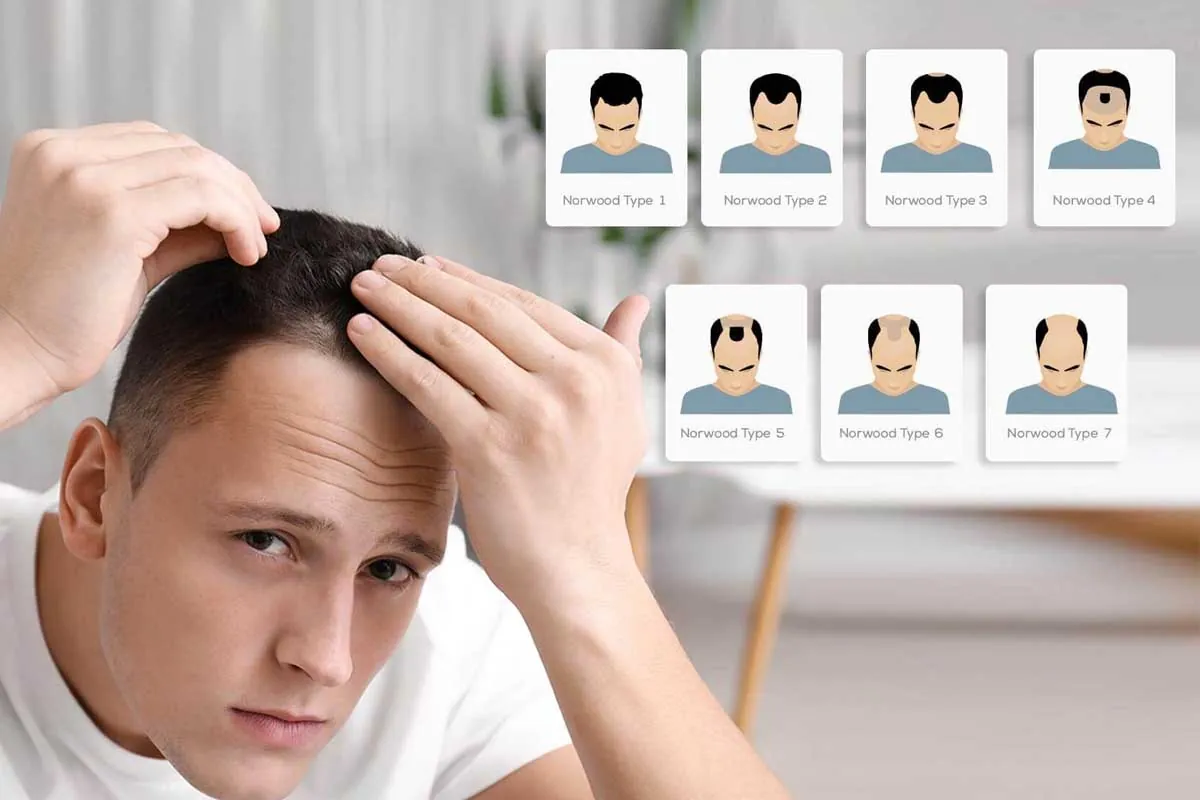 Escala Norwood alopecia masculina Hombre joven revisando entradas junto a escala Norwood de alopecia