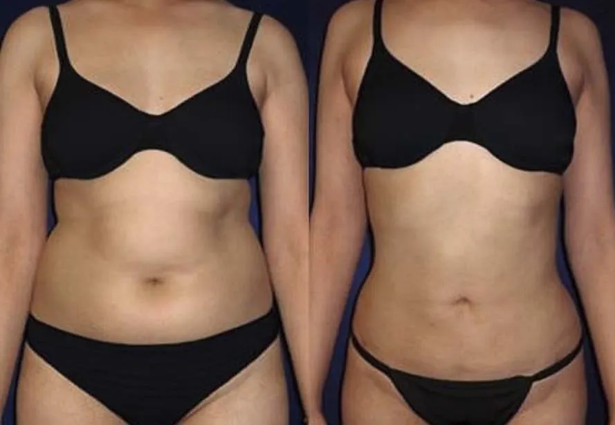 Mesoterapia anticelulítica antes y después, caso 2
