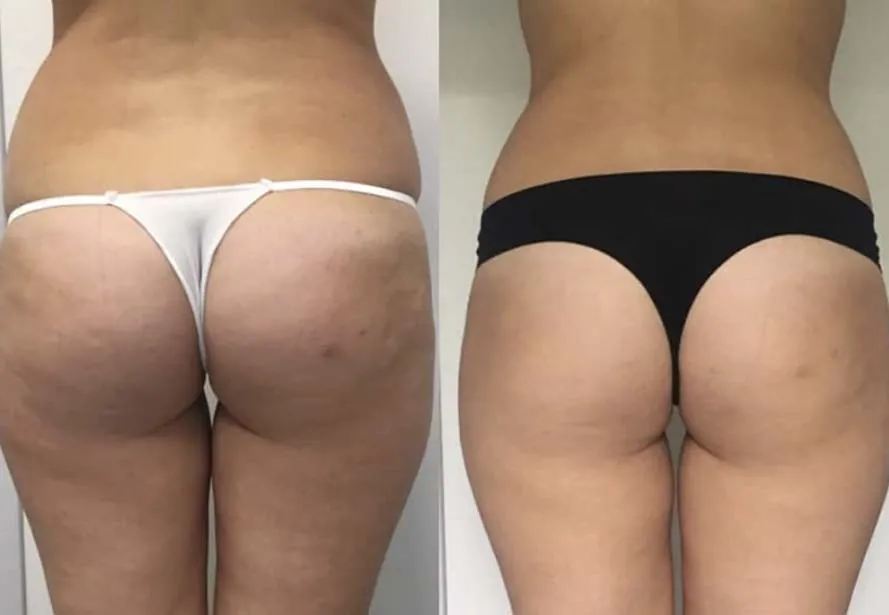 Mesoterapia anticelulítica antes y después, caso 3