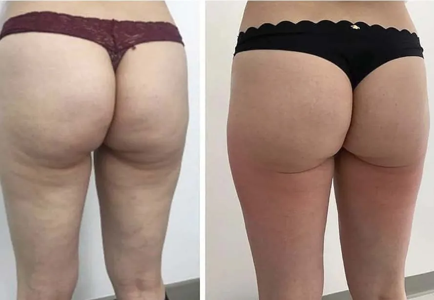 Mesoterapia corporal antes y después, caso 1