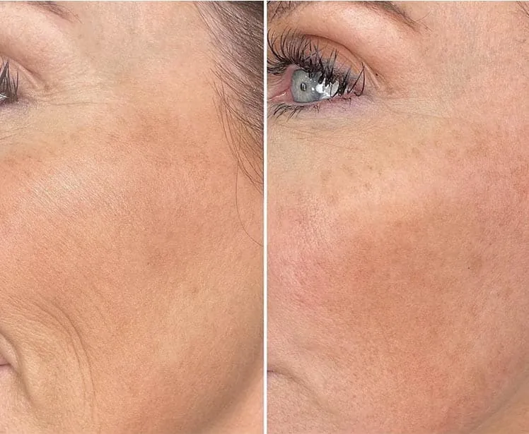 Mesoterapia facial antes y después, caso 1
