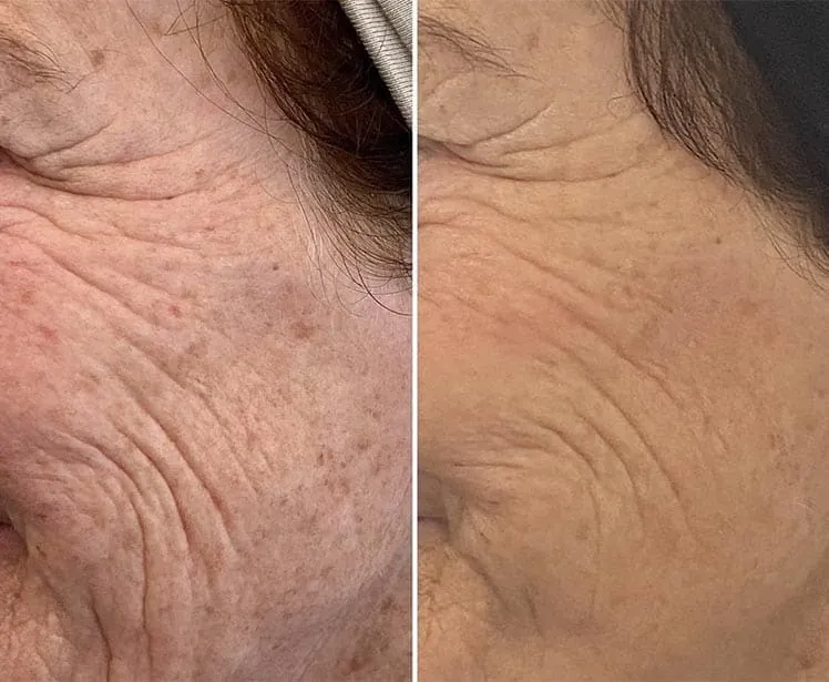 Mesoterapia facial antes y después, caso 2