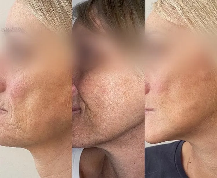 Mesoterapia facial antes y después, caso 3