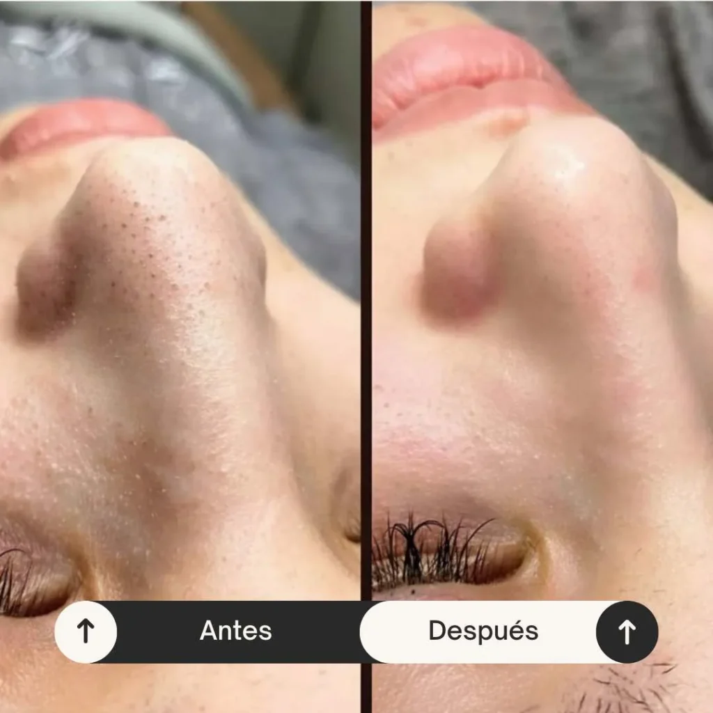 Microdermoabrasión con punta de diamante antes y después