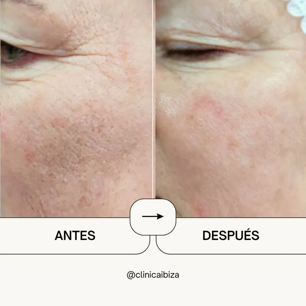 Antes y después de peeling de fenol facial: piel rejuvenecida con menos arrugas y manchas