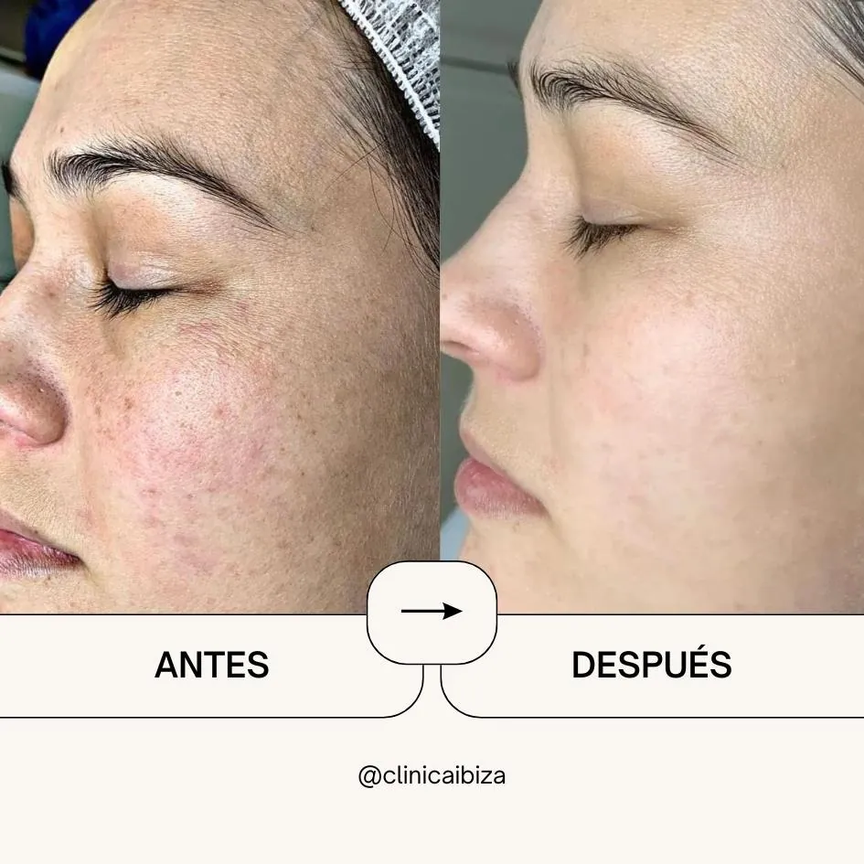 Antes y después peeling fenol facial: piel renovada sin manchas ni rojeces