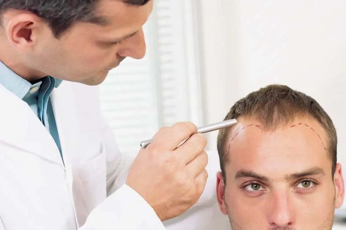 Consulta previa injerto capilar Médico marcando línea frontal para injerto capilar en paciente