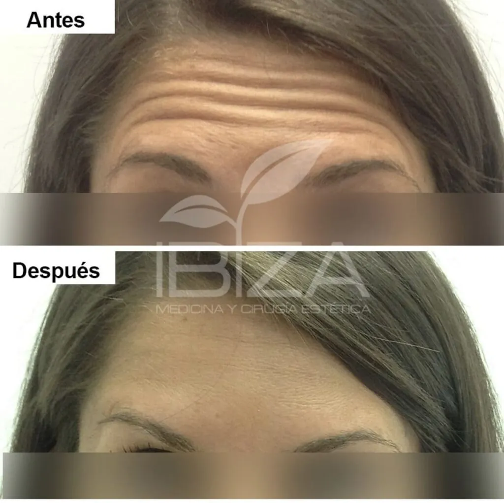 Arrugas frente antes después Antes y después de tratamiento para arrugas de la frente