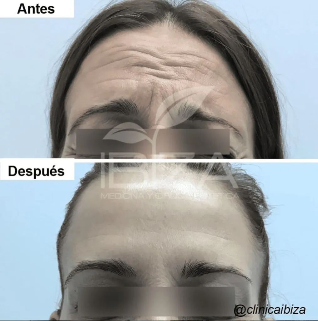 Arrugas frente antes después Antes y después del tratamiento para eliminar arrugas de la frente con bótox